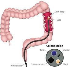 Colonoscopy